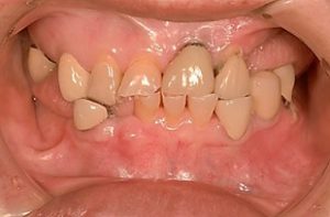 Dental Attrition in an older individual