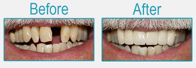 Puentes dentales antes y después 2
