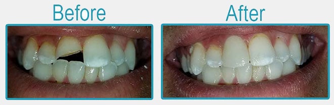 Antes y después - Coronas dentales