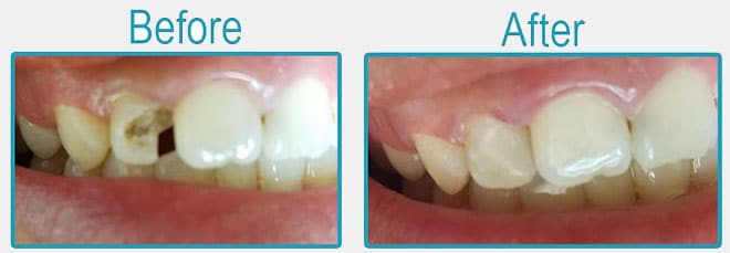 Empaste dental antes y después