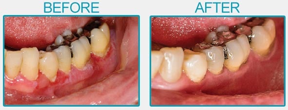 Some Of Wisdom Tooth Extraction Cost