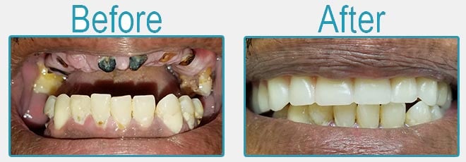 Antes y después - Prótesis dentales