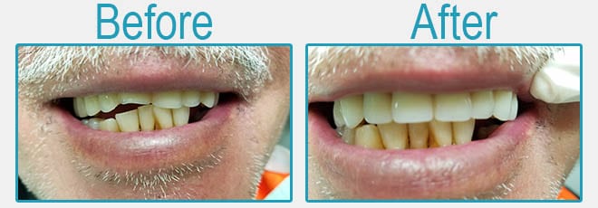 Dentaduras postizas antes y después