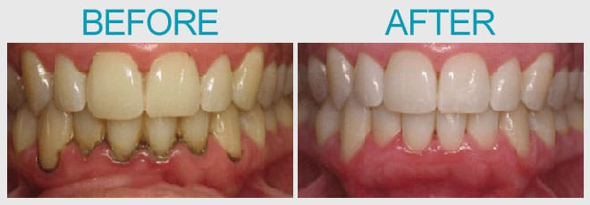 Antes y después del blanqueamiento dental y la gingivitis