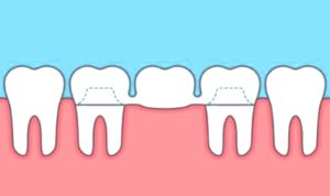 Ejemplo digital de un Puente Dental insertado