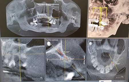 Dental CT Scan Imaging
