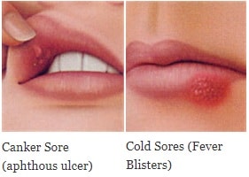 Canker & Cold Sores