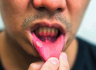 Large Canker Sore