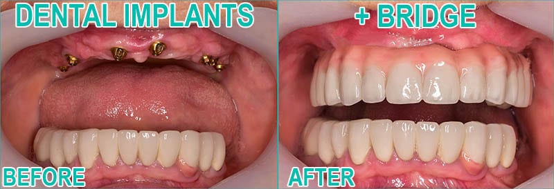 Dental implant and bridge before & after.