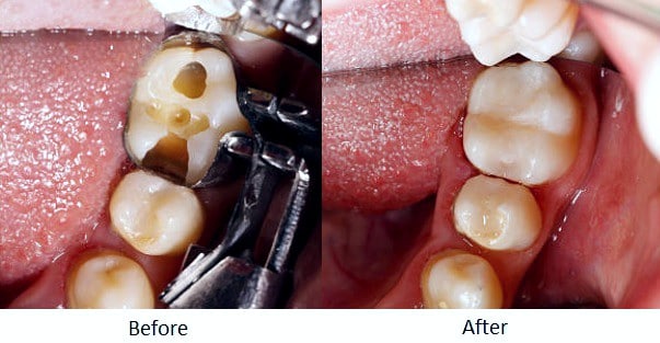 Cavity before and after. Reverse the damages of tooth decay at Oxnard Dentist Carson & Carson, DDS.