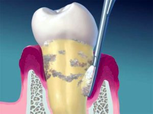 Dentist cleaning below the gumline of tooth.