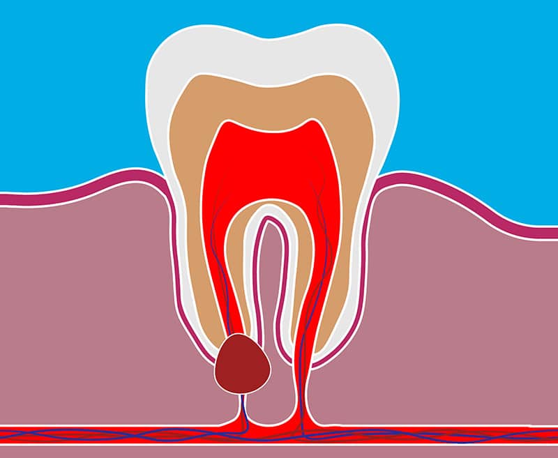 canker sore on cheek near wisdom tooth