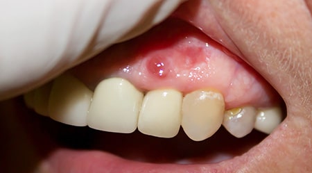 Periapical dental cyst