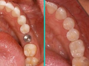 tooth implant before after