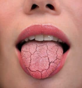 Dry mouth tongue
