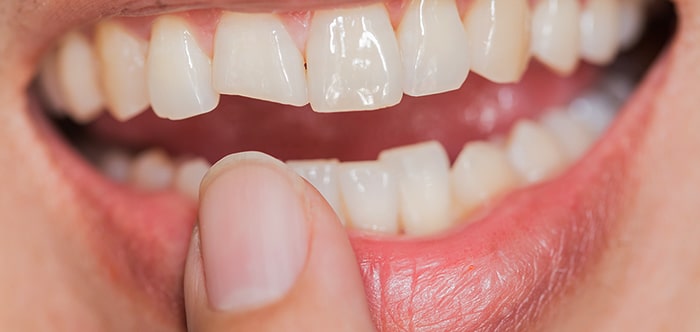 Caring for Teeth - Signs of Calcium Deficiency and How to Get More | Sydney  Park Dental