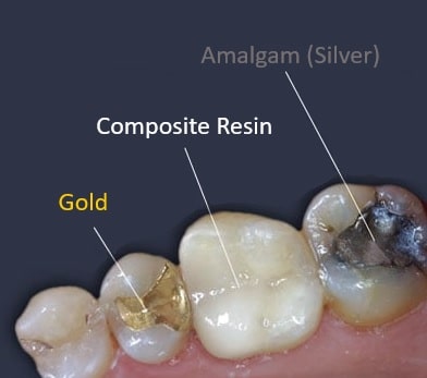 Tipos de empastes ofrecidos en Carson & Carson, DDS en Oxnard, California. Empastes asequibles de dentistas con 45 años de experiencia.