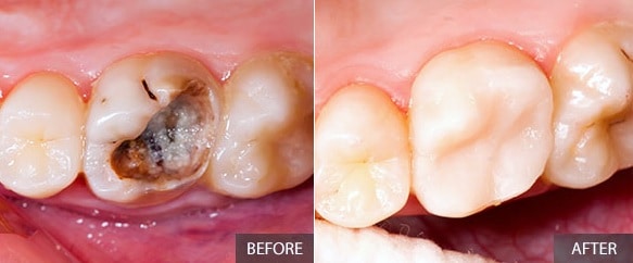 Empastes dentales antes y después. Empastes asequibles del dentista de Oxnard Carson & Carson, DDS.