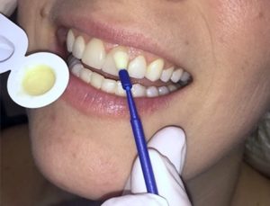 Tratamiento profesional con flúor disponible en Oxnard Dentista Carson & Carson, DDS.