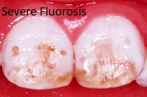 Severe discoloration from fluorosis. Small holes and brown discoloration can be seen.