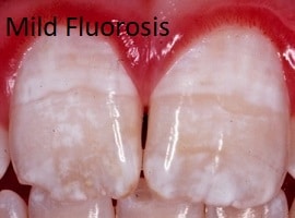 La fluorosis puede provocar la decoloración de los dientes. Se trata de un caso leve en el que la coloración es blanca.