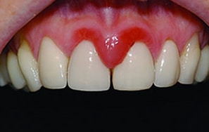 Encías rojas por gingivitis.