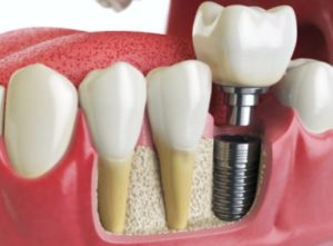Modelo de implante dental. Encuentra implantes dentales asequibles en Oxnard Dentista Carson & Carson, DDS.