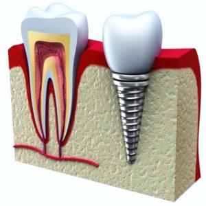 Natural Tooth VS Dental Implant graphic.