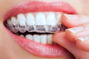 Invisalign, extraíble y casi invisible, es un tratamiento alternativo a los aparatos de ortodoncia para enderezar los dientes y está disponible en Oxnard Dentist Carson & Carson, DDS.