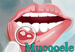 Mucocele (mucuous cyst) graphic