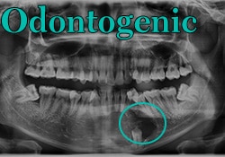 Odontogenic Cyst