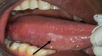 Always keep a look out for odd developments in your mouth. Oral cancer can appear as white discolorations in your mouth.