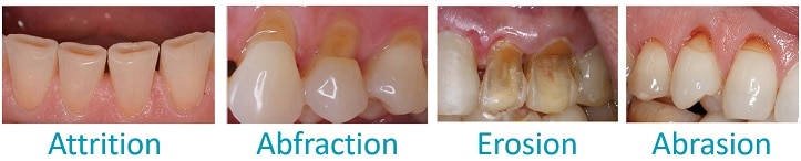 Differences between attrition, abfraction, erosion, and abrasion information at CarsonDDS.com