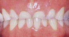Bruxism (teeth grinding) can leave you with little to no teeth left.