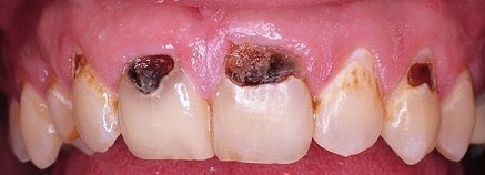 Examples of cavities & tooth decay from Oxnard dentist Carson & Carson, DDS.