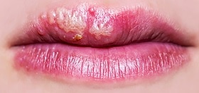 Cold sores can be a drag.