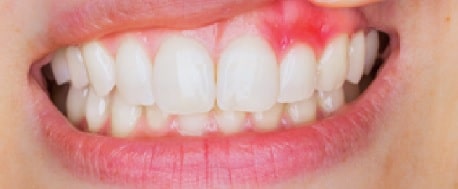 Gingivitis is the lesser and still fixable form of gum disease. Learn more about Periodontal disease at CarsonDDS.com