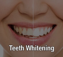 Antes y después del blanqueamiento dental del dentista de Oxnard, CarsonDDS