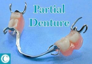Set of Partial Dentures