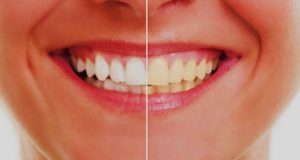 Antes/Después del blanqueamiento dental
