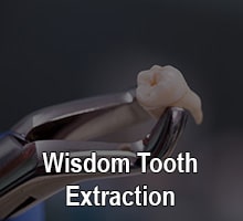 Wisdom tooth extracted by Oxnard Dentist