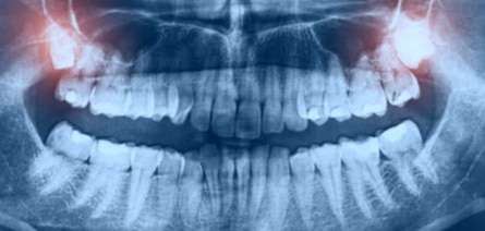 Evita las molestias de la extracción de las muelas del juicio con las opciones de sedación durante el sueño que ofrece el dentista de Oxnard Carson & Carson, DDS.