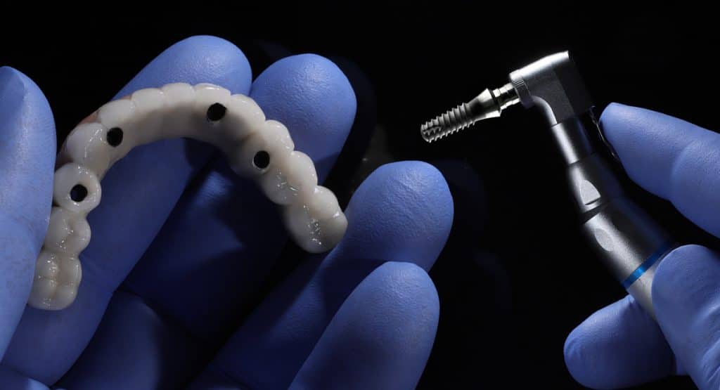 all on 4 dental implants teeth with a drill bit