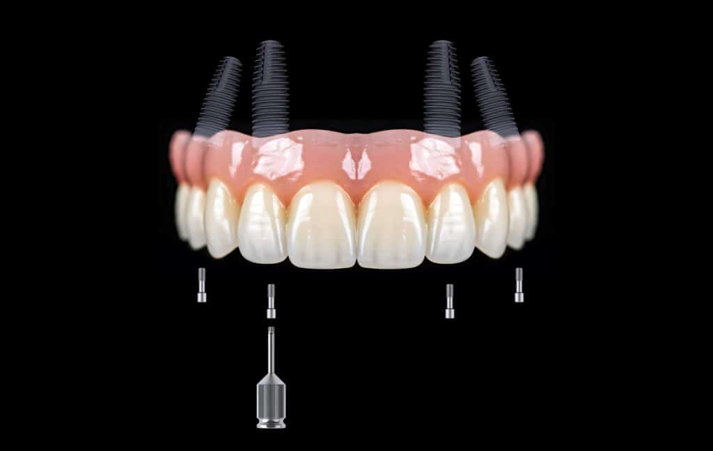 all on 4 dental implants upper