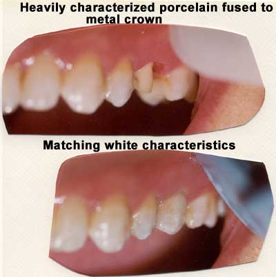 Reparación de corona de porcelana fundida sobre metal muy caracterizada.