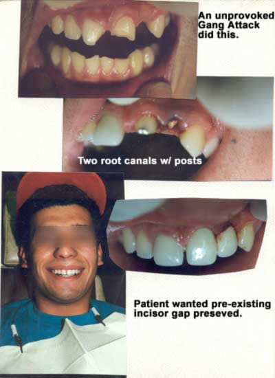 Dos endodoncias y postes para reparar los daños de los dientes frontales por un ataque no provocado de una banda