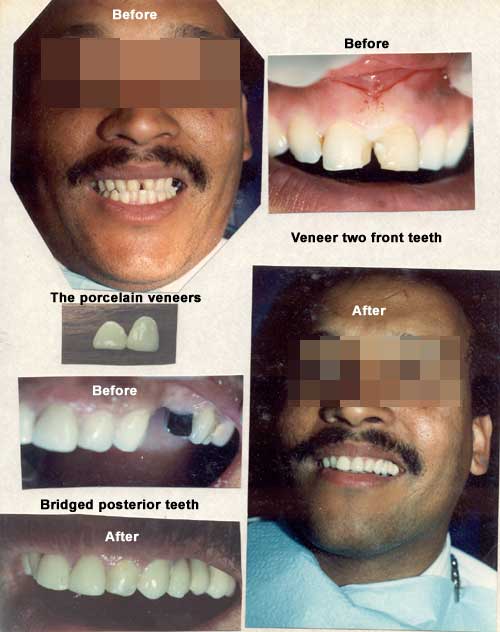 Carillas de porcelana instaladas en los dientes delanteros