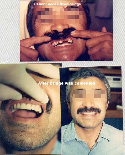 Puente fijo de dientes frontales