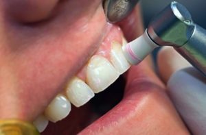 Polishing step in teeth cleaning at Oxnard dentist Carson & Carson, DDS.