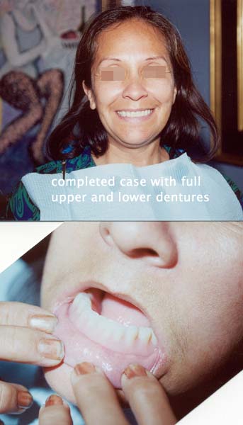 Completed case with full upper and lower dentures